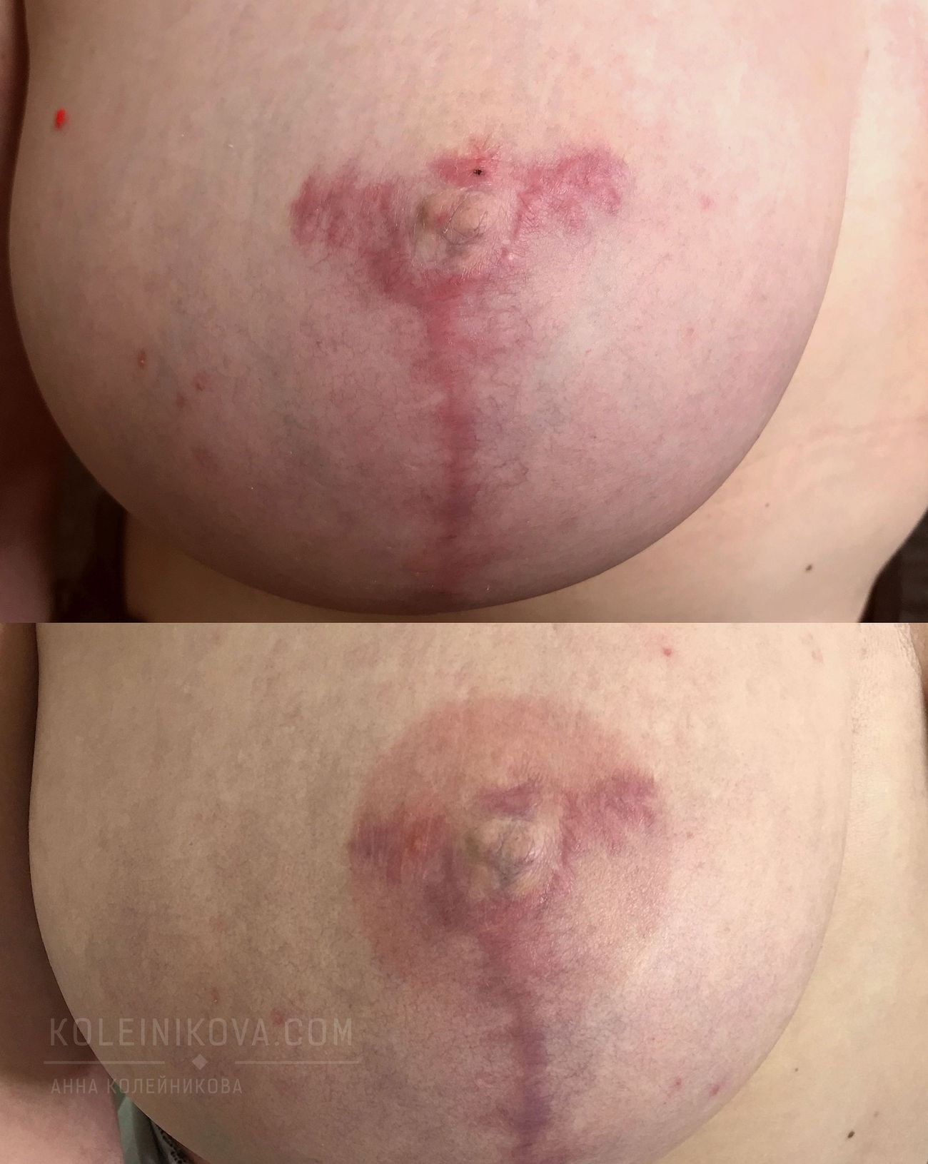 Darkened Areolas Causes Explained By Dr. Jill