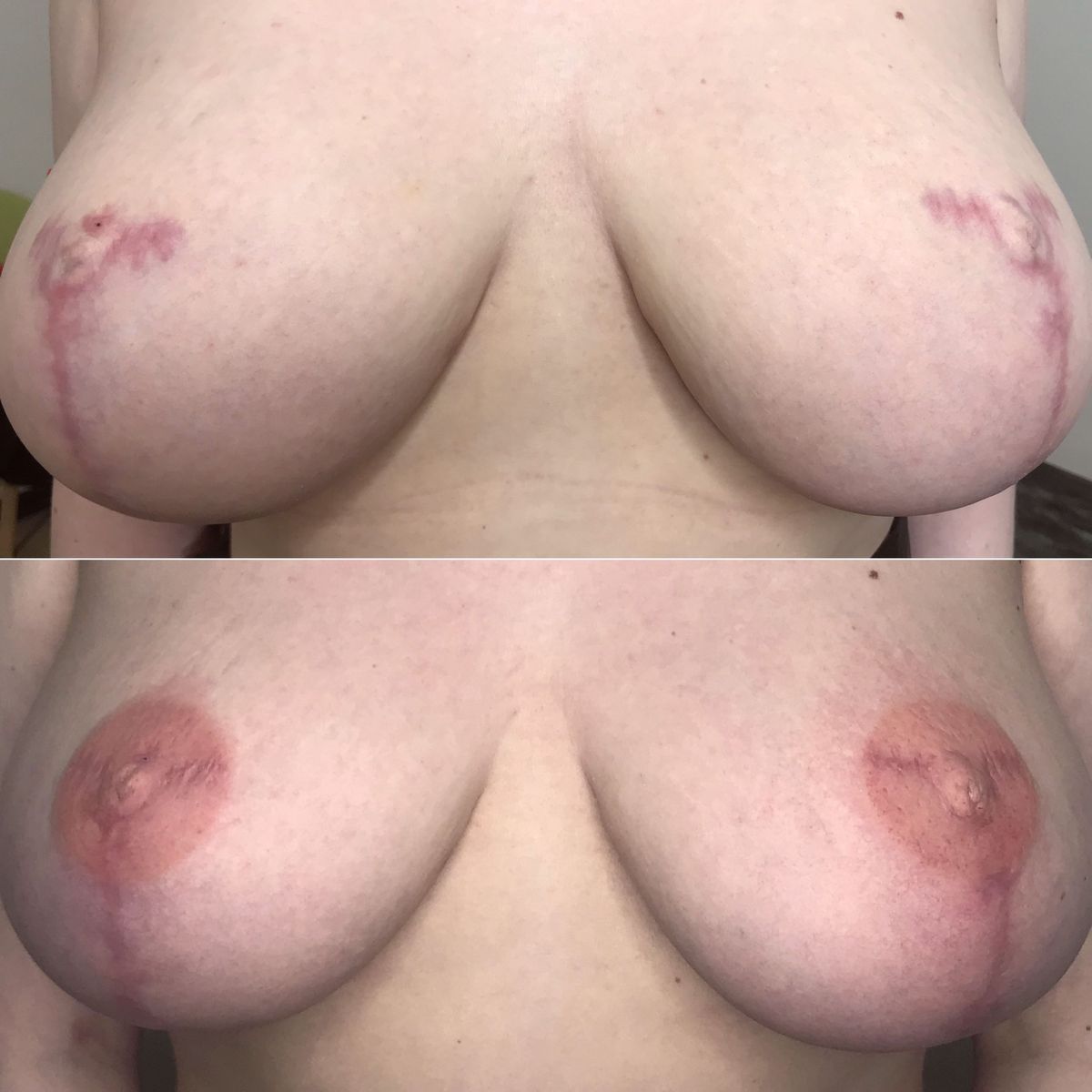 гематома в груди у женщин фото 66